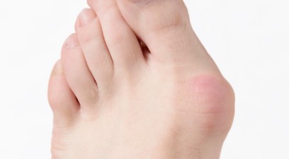 Imagen de la noticia: Estas son las razones por las que nos salen juanetes