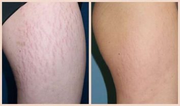 Imagen de la noticia: Dile adiós a las estrías: el remedio casero con aceite de oliva que realmente funciona